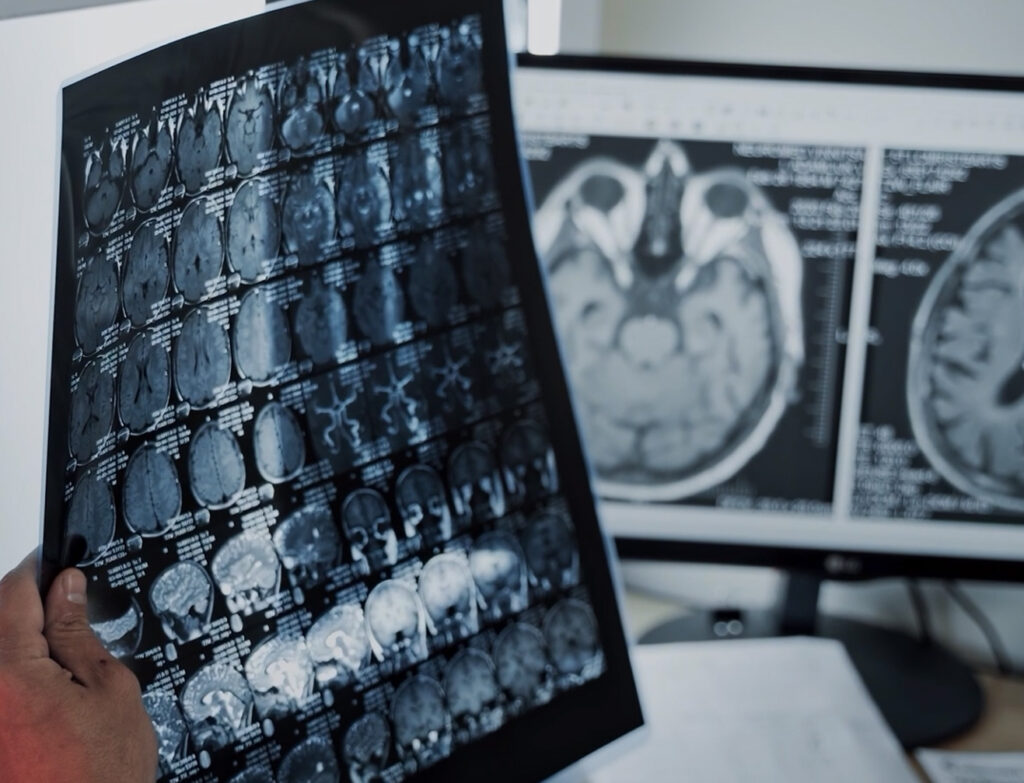 Meningeome Symbolbild