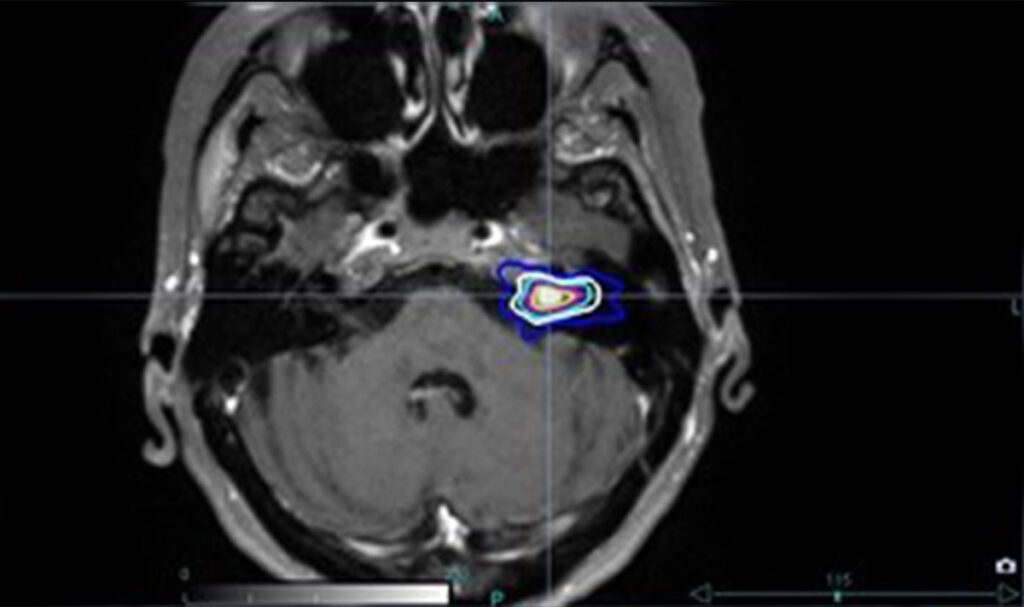 akustikusneurinom fallbeispiel
